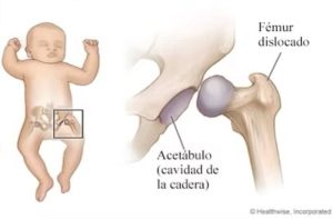 displasia de cadera